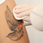How to Prepare for Tattoo Removal