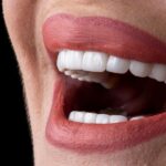 All Your Questions About Veneers Answered by Cartersville Dental Experts